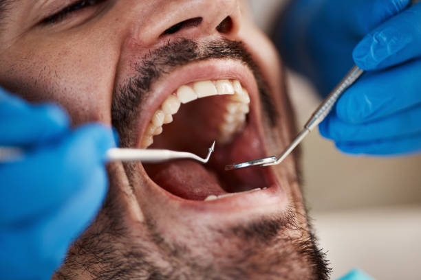 Best Emergency Tooth Extraction in Angleton, TX